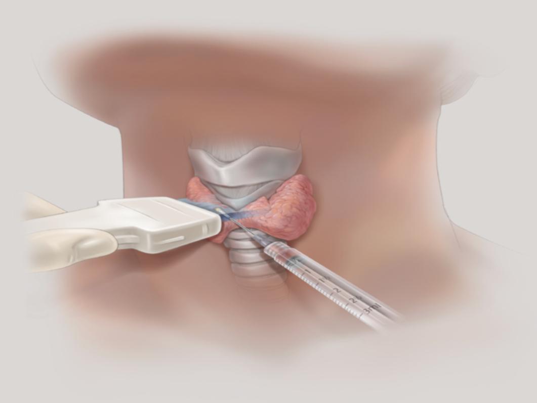 Тонкоигольная асприационная биопсия щитовидной железы в Черкесске | Евромед  | Хирург в Черкесске